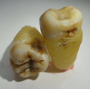 extrahierte Zähne