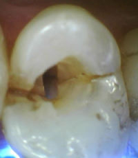frakturierter Zahn
