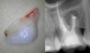 Röntgen des zerbrochenen Zahnes
