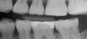 abradierte Zähne