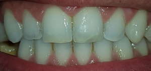 normale Zahnstellung