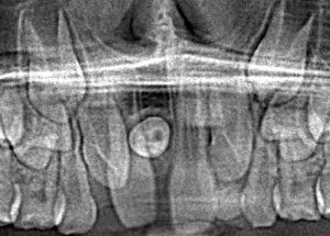 Röntgenbild eines Mesiodens
