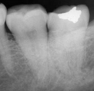 Rx des gespaltenen Zahns