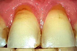 Knirschen ohne Zahnhalsdefekt
