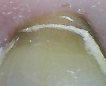 Mikroriss im Zahnhalsdefekt