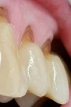 stumpfwinkliger keilförmiger Zahnhalsdefekt