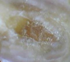 Dentikel verschliessen die Pulpakammer