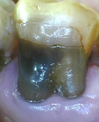 Zahn mit totem Nerv
