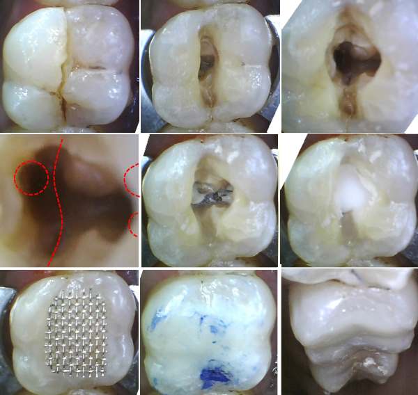 Grau wird wurzelbehandelter zahn Wurzelbehandlung