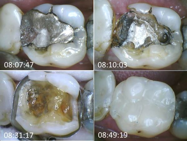Grau zahn verfärbt sich Schwarze Zähne