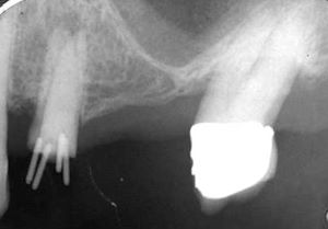 Krone querfrakturiert