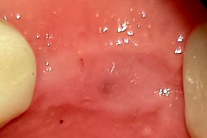 Gingiva &uuml;ber Implantat