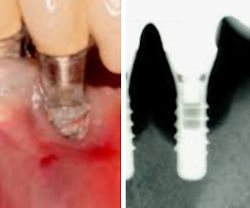 Periimplantitis