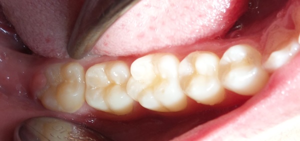 Gegen weisheitszahn zahnfleisch drückt Druckschmerz Zähne