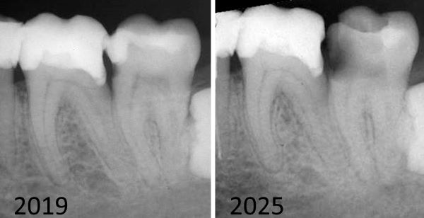 705KariesInterdental6739.jpg